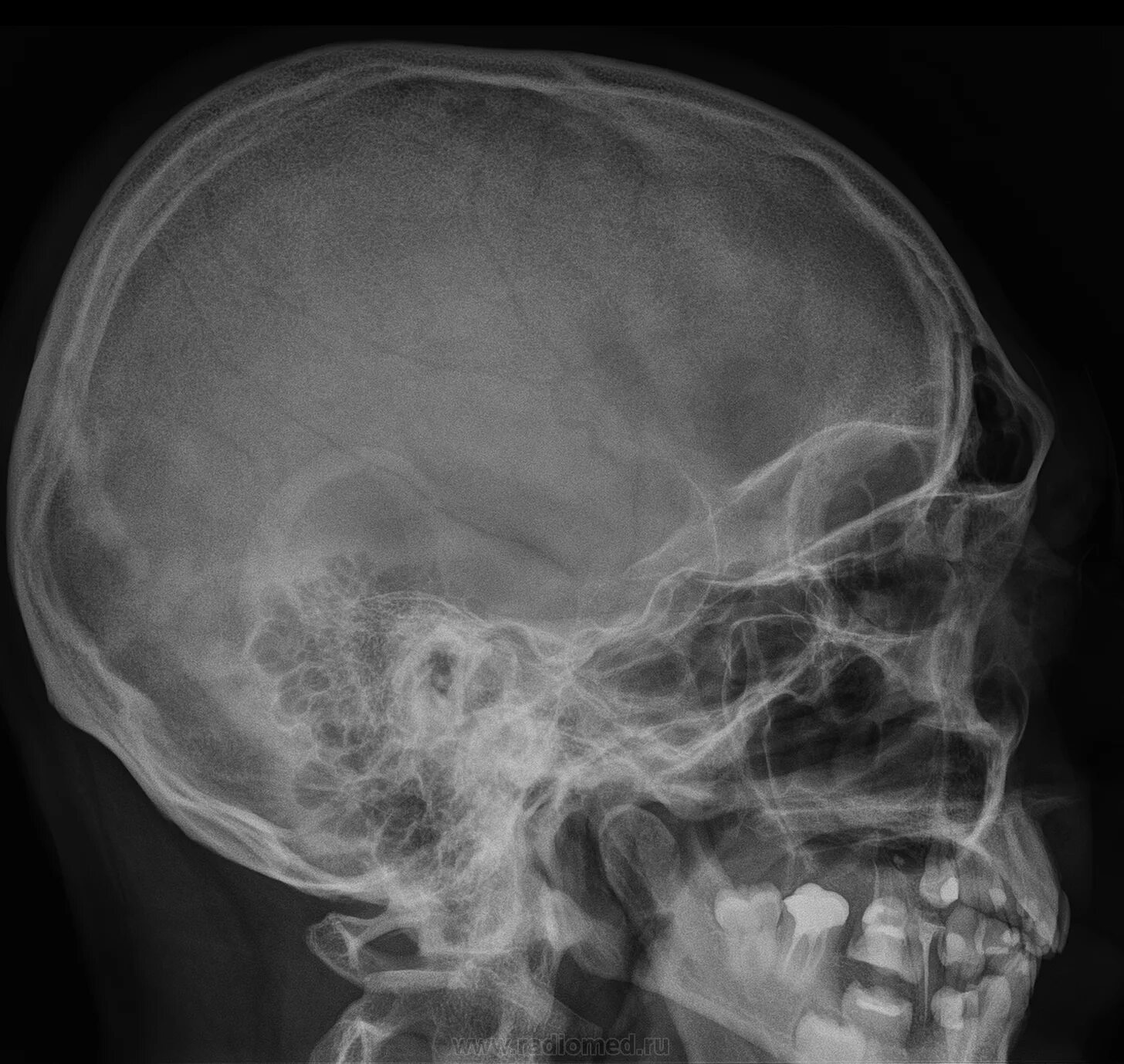 Рентген черепа фото Рентгенография черепа в двух проекциях. Портал радиологов