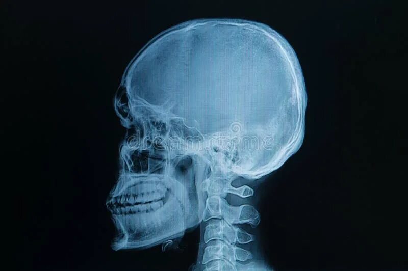 Рентген черепа фото Skull x-rays image stock image. Image of anatomy, examine - 42597699