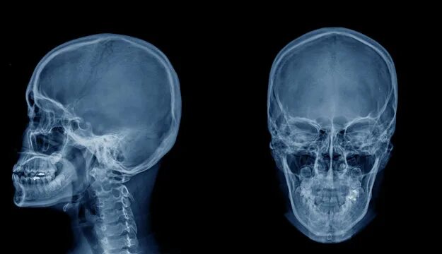 Рентген черепа фото Skull X-Ray Изображения: просматривайте стоковые фотографии, векторные изображен