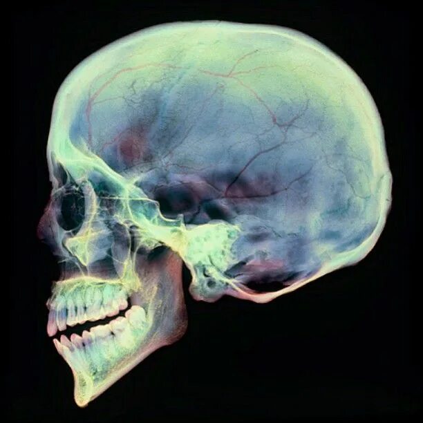 Рентген черепа фото A colored X-ray of a sagittal section through a human skull from a lateral view.