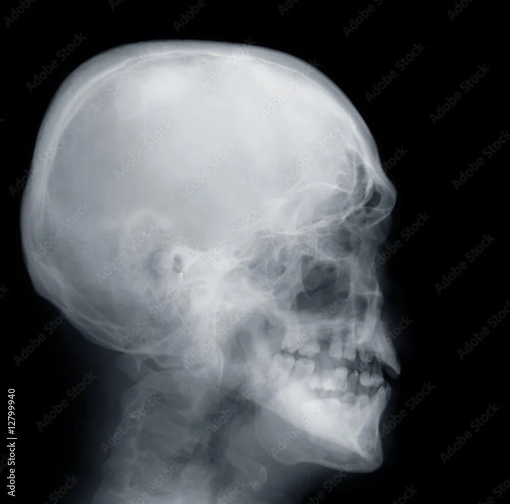 Рентген черепа фото X-ray of a human skull фотография Stock Adobe Stock