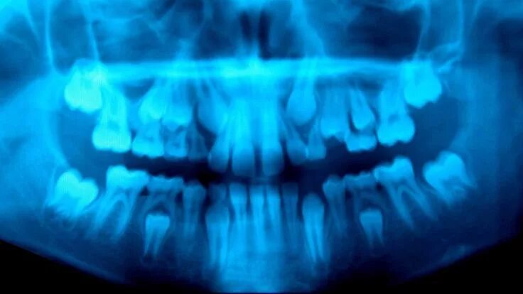 Рентген детских зубов фото Spotting Vitamin D Deficiency Early: Insights from Ancient Skeletons