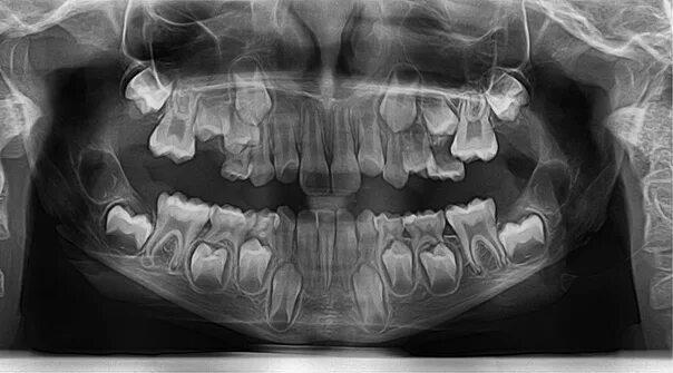 Рентген детских зубов фото Зачем детям исследование ОПТГ ❓ ❗ Если проведение рентгена у подростков и взросл