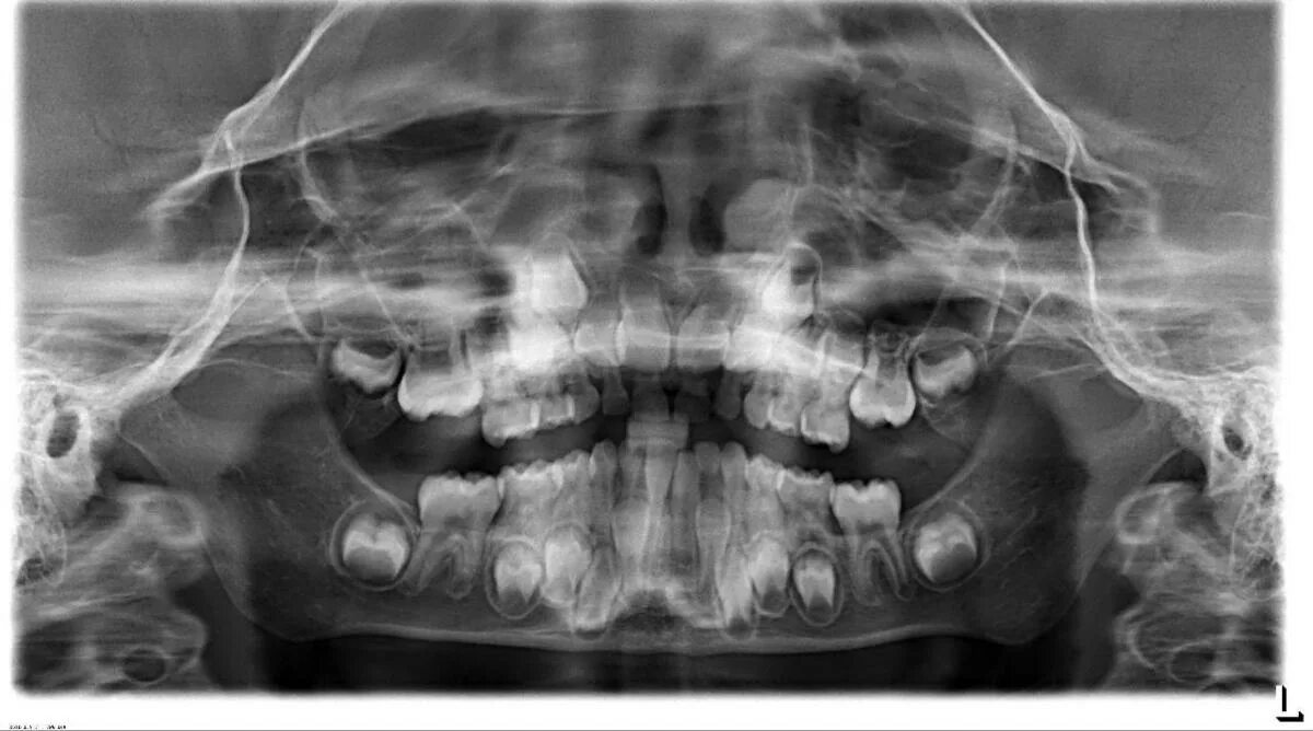 Рентген детских зубов фото Скученность зубов у ребенка - Ортодонтия - Форум стоматологов (стоматологический