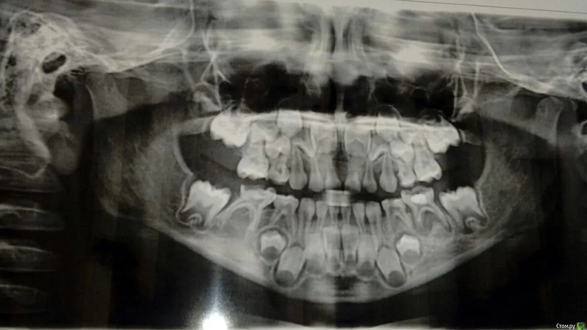 Рентген детских зубов фото Отсутствие зачатков, так ли это - Ортодонтия - Стоматология для всех