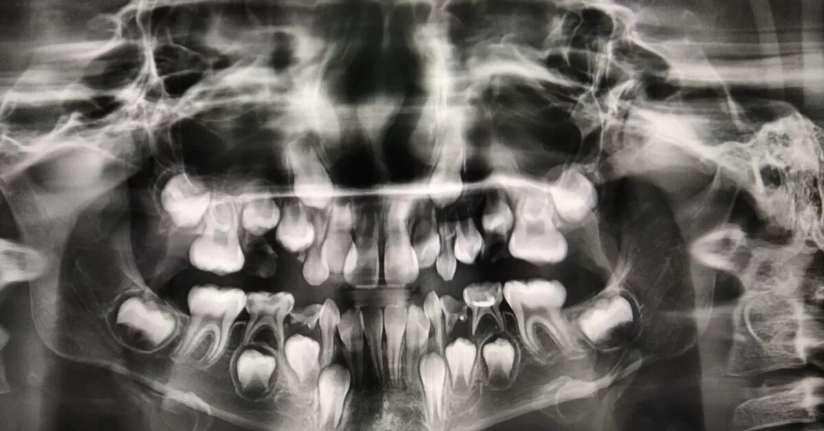 Рентген детских зубов фото Рентген зубов ребенка Пикабу