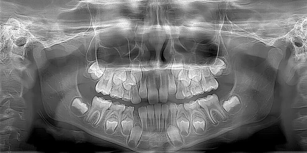 Рентген детских зубов фото How to Get a Panoramic Dental X-Ray, Costs & Procedure