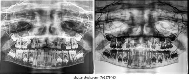 Рентген детских зубов фото Deciduous Tooth X Ray: изображения, стоковые фотографии и векторная графика Shut