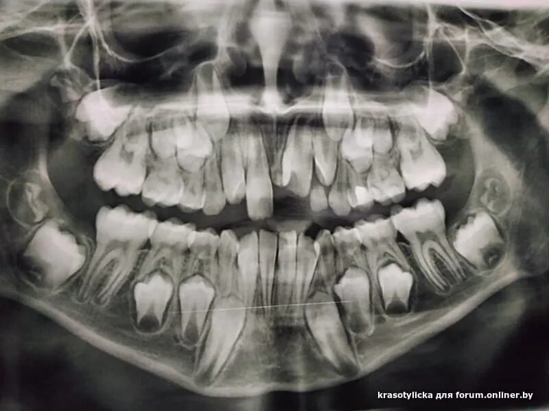 Рентген детских зубов фото Детский рентген воронеж