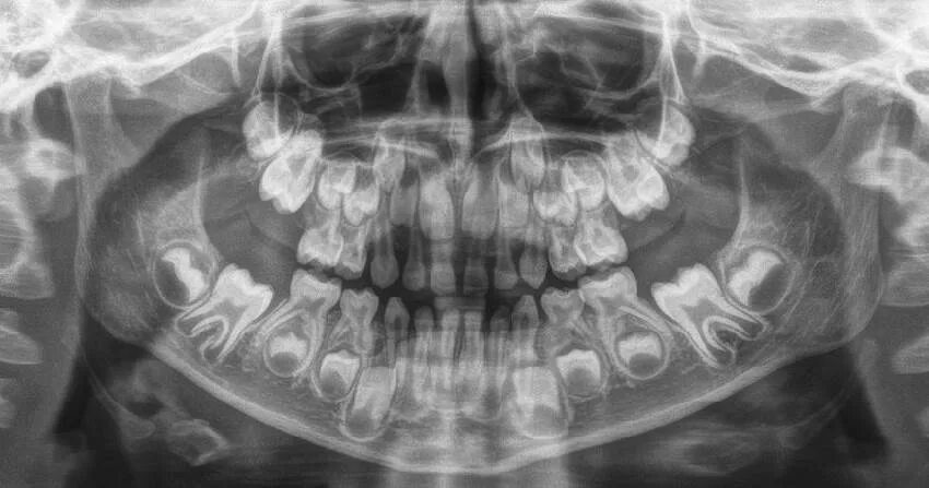 Рентген детских зубов фото Зачатки зубов и этапы их формирования