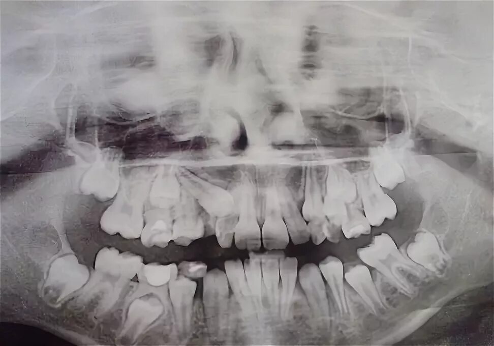 Рентген детских зубов фото Консультация ортодонта: исправление прикуса у ребенка 9 лет пластинкой