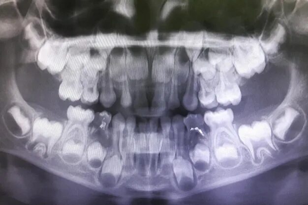 Рентген детских зубов фото Стоматологический рентген Премиум Фото