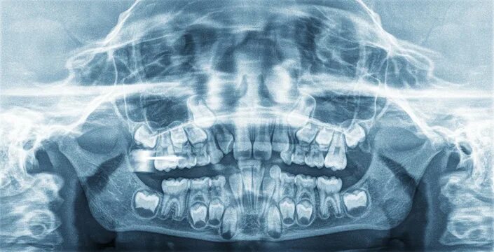 Рентген детских зубов фото Imágenes de Child Xray: descubre bancos de fotos, ilustraciones, vectores y víde