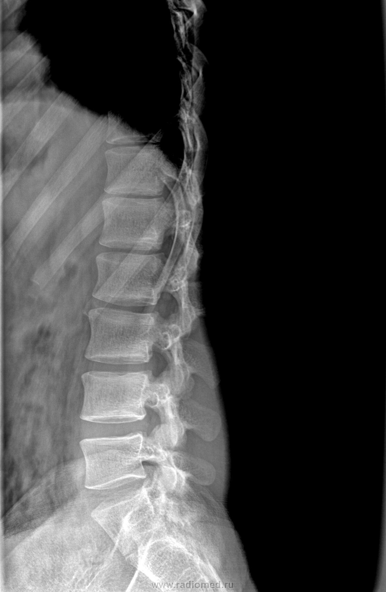 Рентген грудного отдела фото Рентген грудного отдела позвоночника описание, фото, цена