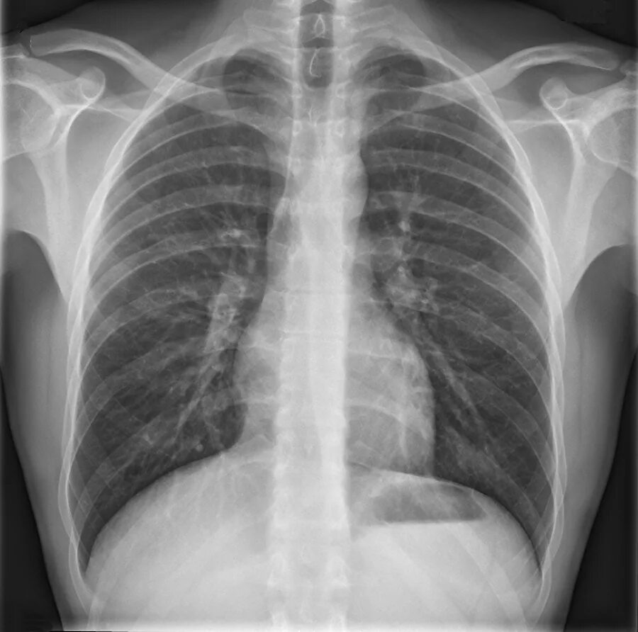 Рентген грудного отдела фото New chest X-ray AI app could help relieve reporting backlog in the UK