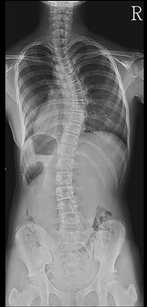 Рентген грудного отдела фото Differential wedging of vertebral body and intervertebral disc in thoracic and l