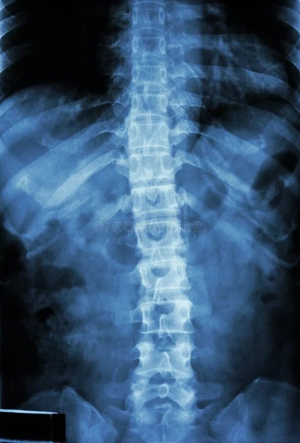 Рентген грудного отдела фото Dramatic Spine, Ribs Fracture. CT-scan Reconstruction. Stock Image - Image of lu