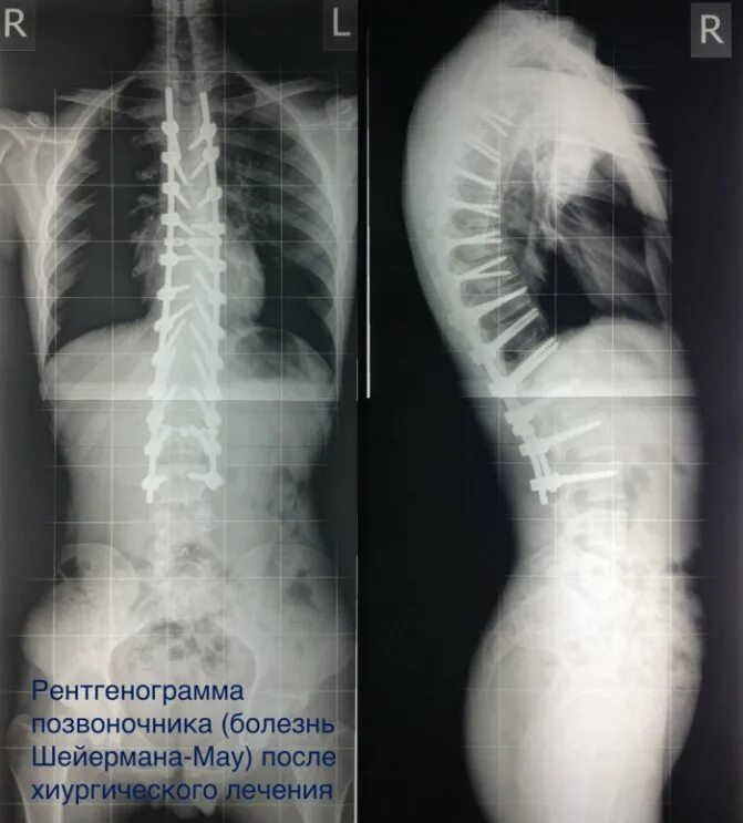 Рентген грудного отдела позвоночника фото Болезнь Шейермана-Мау - причины, симптомы, диагностика и лечение
