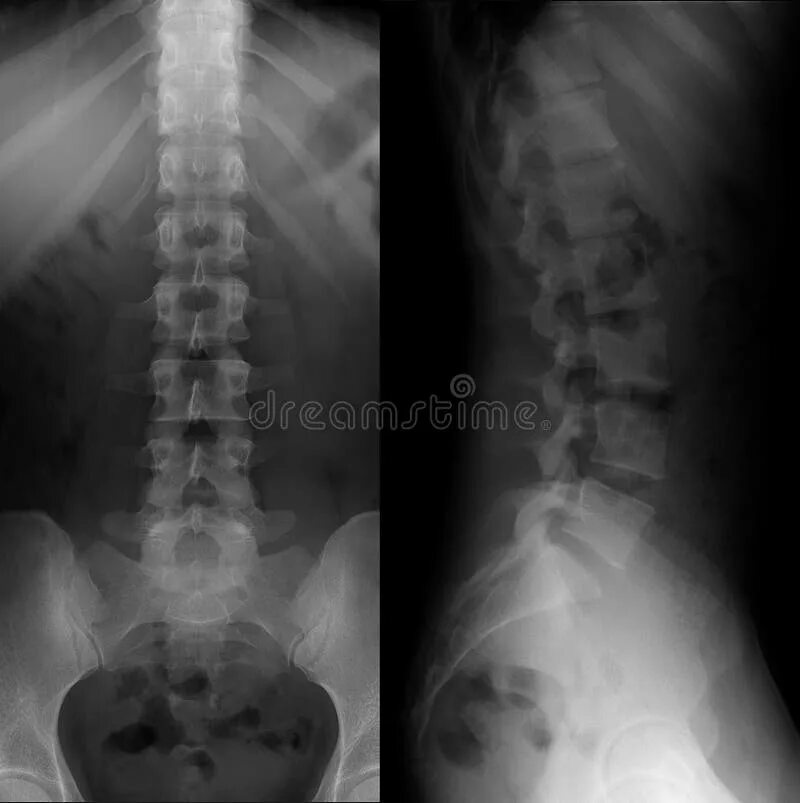 Рентген грудного отдела позвоночника фото 7,135 Lumbar стоковые фото - бесплатные и стоковые фото RF от Dreamstime - Стран