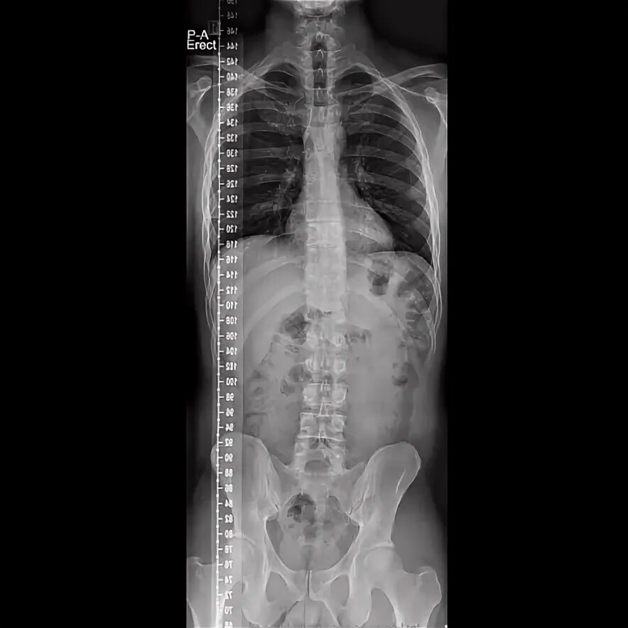 Рентген грудного отдела позвоночника фото Long spine x-rays (minimal scoliosis) Radiology Case Radiopaedia.org