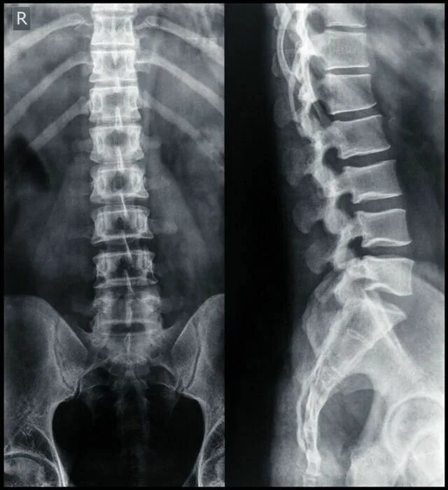 Рентген грудного отдела позвоночника фото Рентгенография
