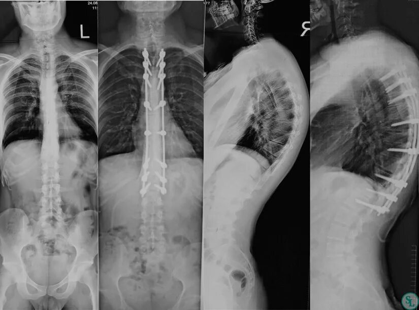 Рентген грудного отдела позвоночника фото Хирургическое лечение гиперкифоза грудного отдела позвоночкана фоне Б-ни Шейерма