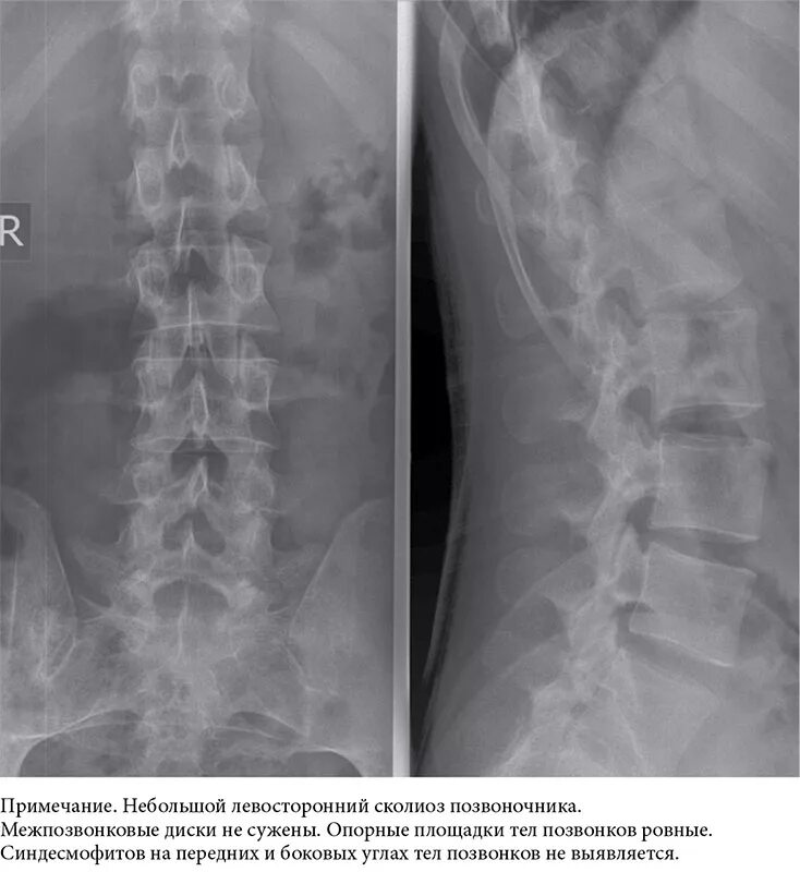 Рентген грудного отдела позвоночника фото Поздняя диагностика анкилозирующего спондилита с ювенильным началом (клиническое