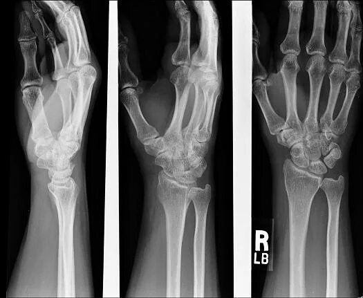 Рентген лучевой кости фото Placement Of Needles For Upper Extremity Emg