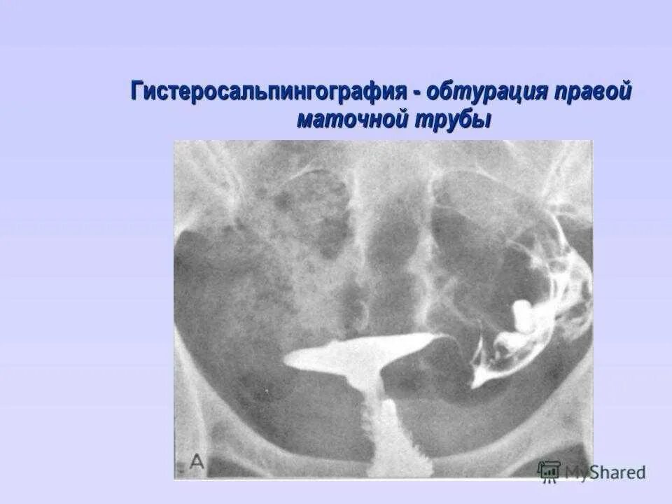 Рентген маточных труб фото Почему трубы не проходимы - найдено 87 картинок