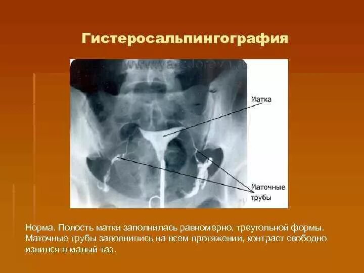 Рентген маточных труб фото Гсг рентген маточных