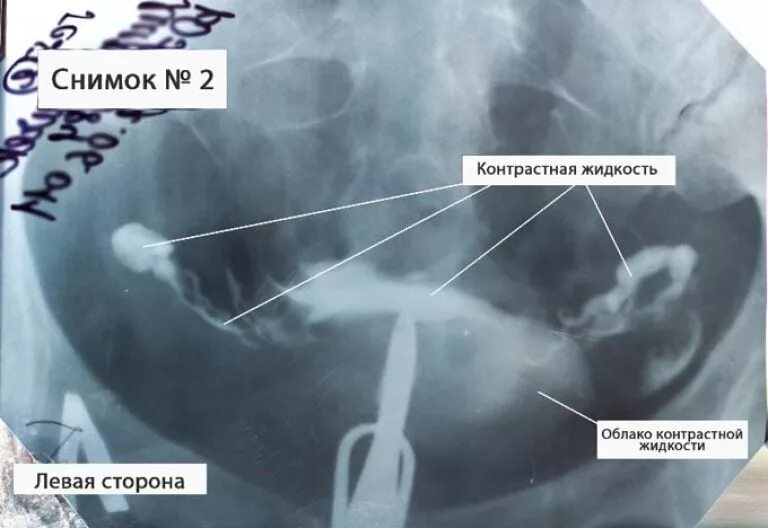 Рентген маточных труб фото Рентген маточных труб: как делают, больно ли, стоимость процедуры