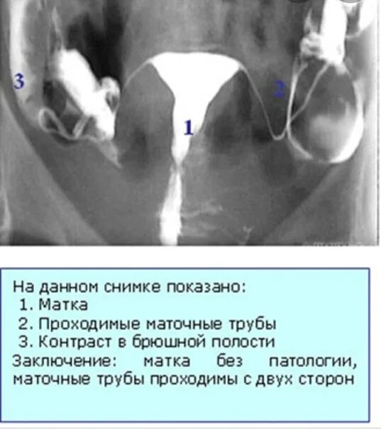 Рентген маточных труб фото Больные маточные трубы: найдено 88 изображений