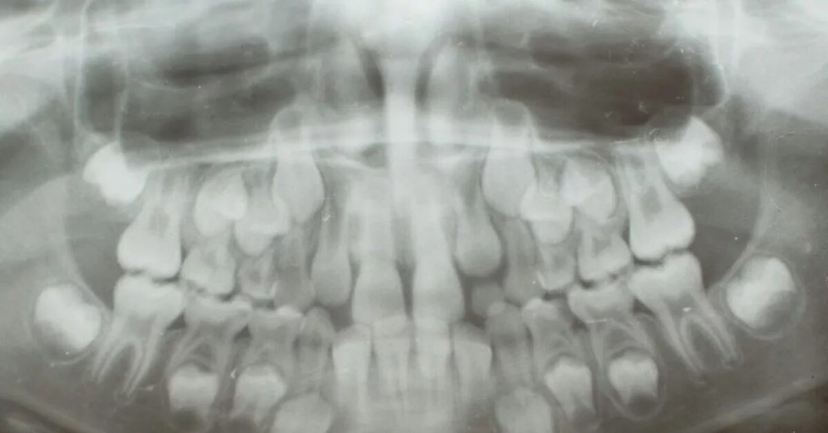 Рентген молочных зубов фото Как выглядит череп ребенка до выпадения молочных зубов Пикабу