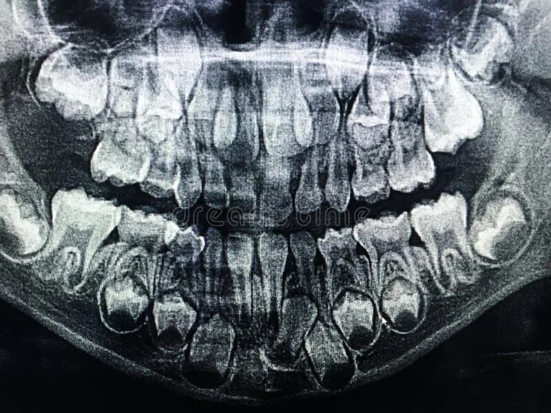 Рентген молочных зубов фото Dental X-Ray of Child 6 Years, All Baby Teeth in View. Stock Photo - Image of pa