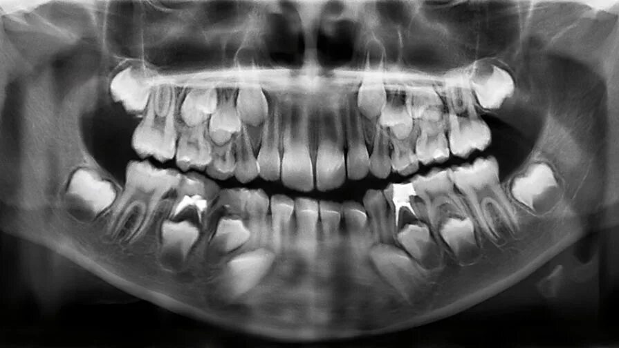 Рентген молочных зубов фото Психиатры: болезни психики можно выявить по молочным зубам - Газета.Ru