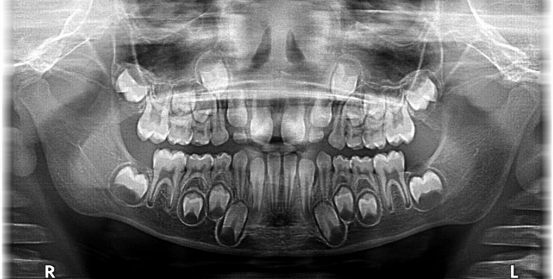 Рентген молочных зубов фото Plik:Deciduous teeth-boy-OPG-10,10,2019.jpg - Wikipedia, wolna encyklopedia