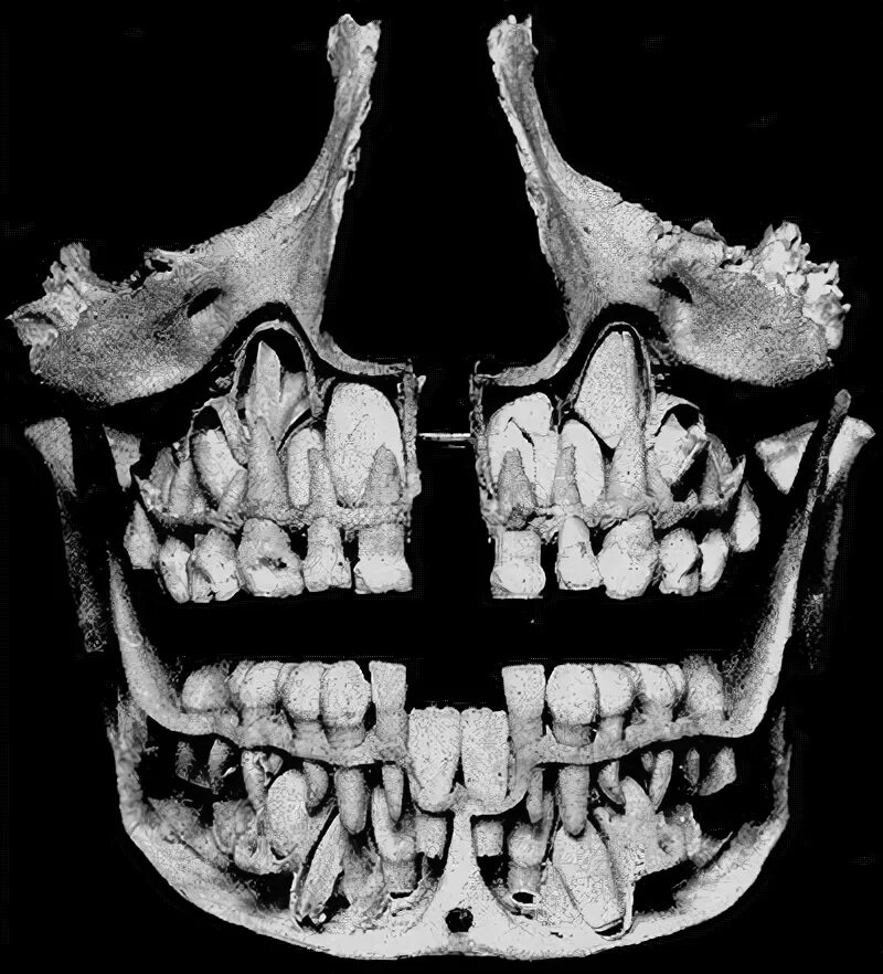 Рентген молочных зубов фото Deciduous teeth - Wikipedia