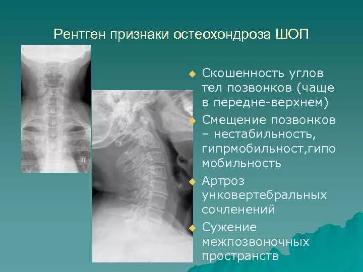 Рентген остеохондроза грудного отдела фото Заострения углов тел позвонков