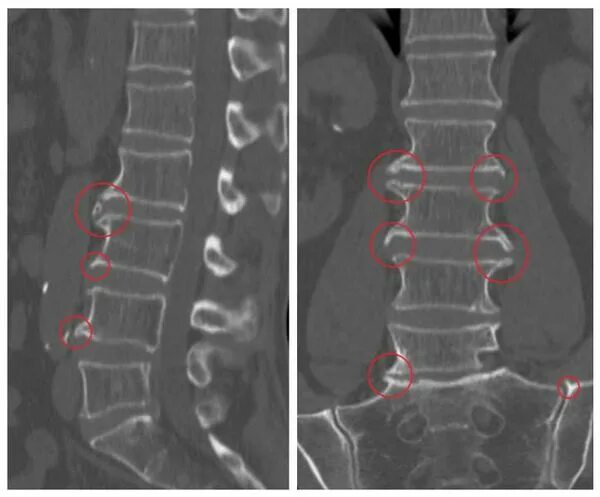 Рентген остеохондроза грудного отдела фото Спондилез поясничного отдела позвоночника: что это такое и лечение в статье невр
