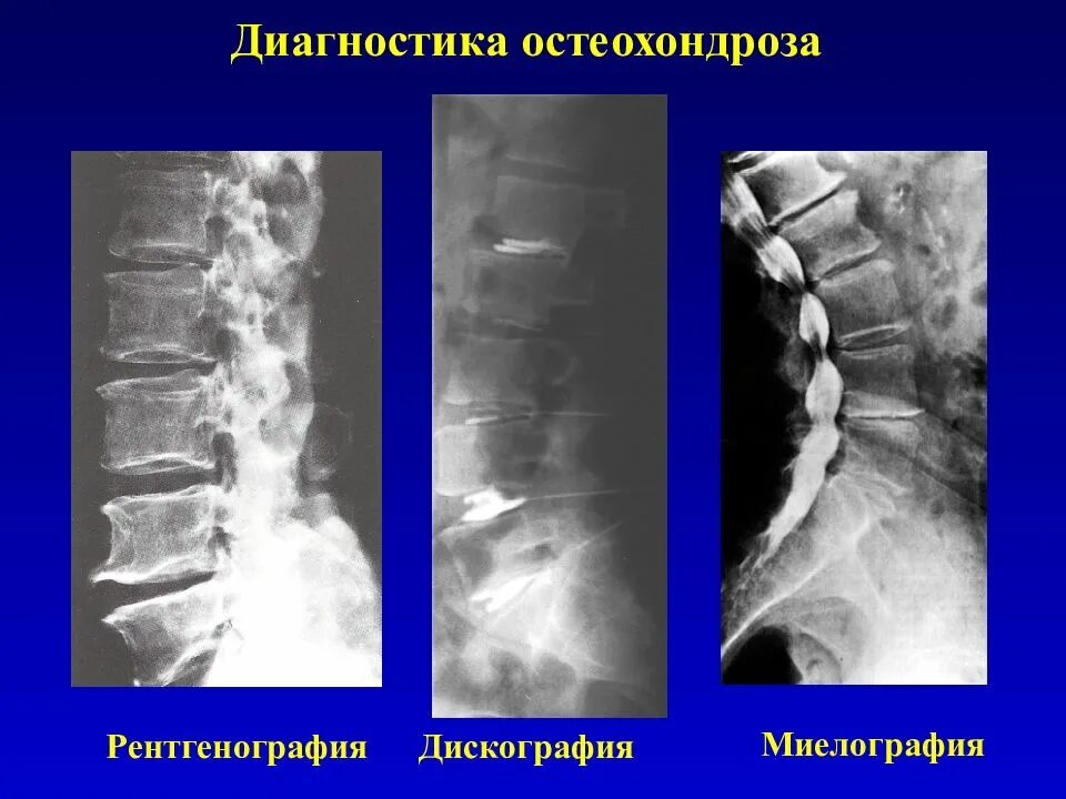 Рентген остеохондроза грудного отдела фото Шейный отдел диагностика