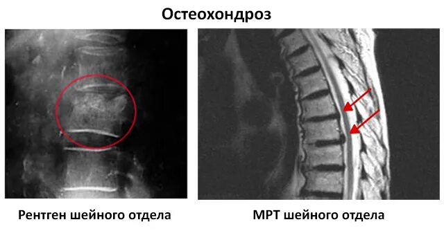 Рентген остеохондроза грудного отдела фото Остеохондроз грудного отдела позвоночника: симптомы и лечение, причины pricemedi