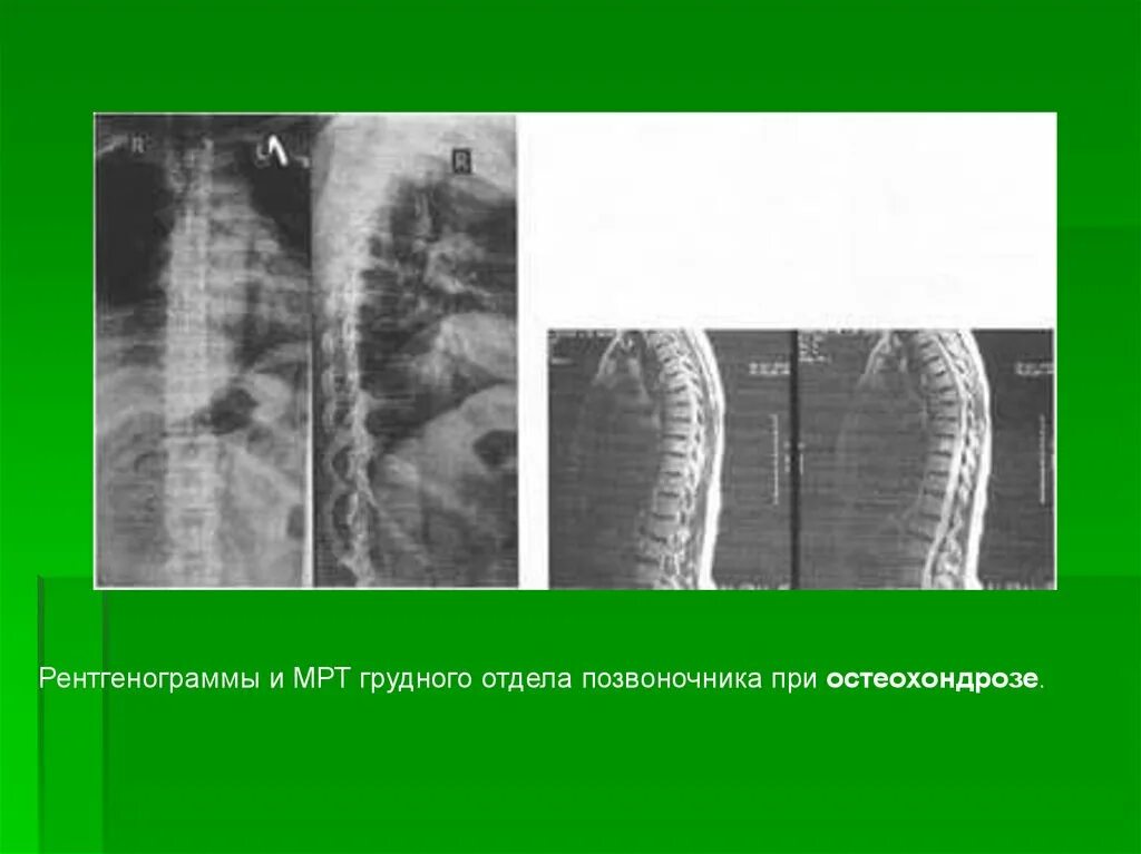Рентген остеохондроза грудного отдела фото Рентгендиагностика остеохондроза - презентация онлайн