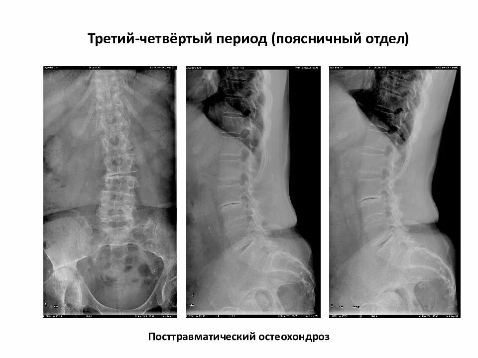 Рентген остеохондроза грудного отдела фото Остеохондроз шейного отдела степени