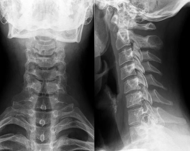 Рентген остеохондроза грудного отдела фото Raio x do pescoço e coluna cervical Foto Premium Coluna cervical, Anatomia dos o