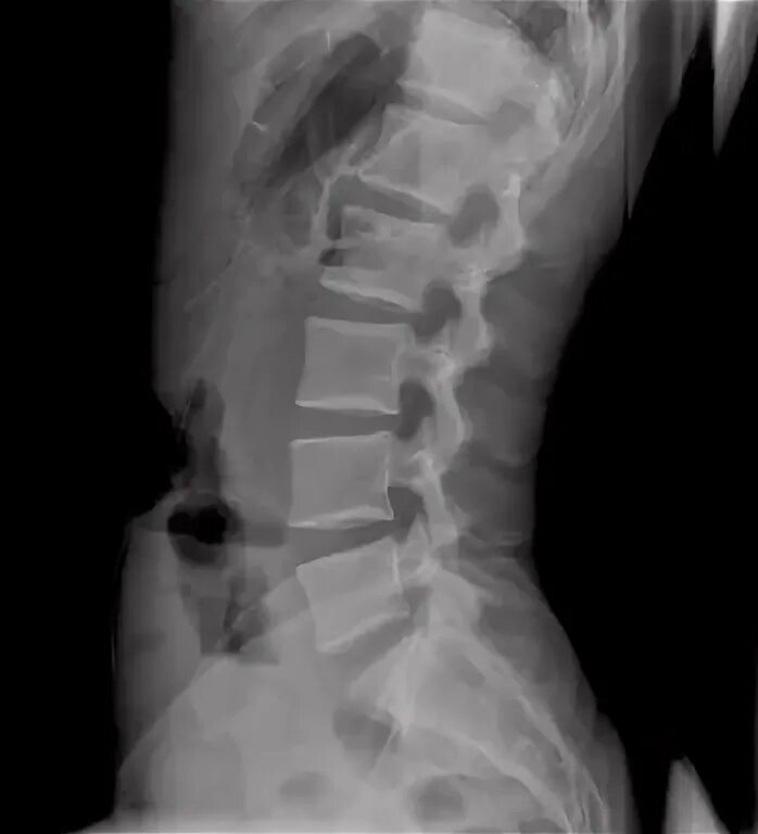 Рентген остеохондроза грудного отдела фото Radiografía de la columna lumbar, perfil Columna lumbar, Lumbares, Columnas