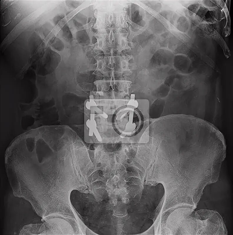 Рентген пояснично крестцового отдела фото Rayos x lumbo-sacro columna vertebral y pelvis fotomural * fotomurales sacro, fé