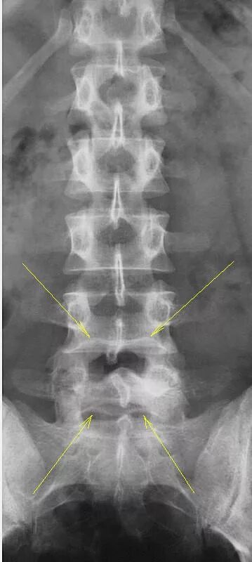 Рентген пояснично крестцового отдела фото Рентгенография шейного и поясничного отдела позвоночника. Портал радиологов