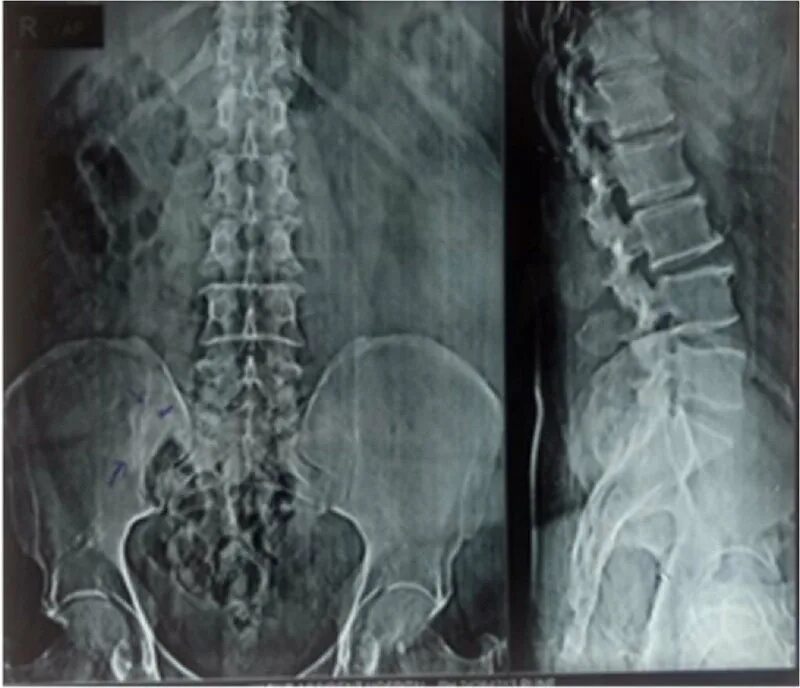 Рентген пояснично крестцового отдела фото Pre-operative radiograph of lumbosacral spine anteroposterior and... Download Sc