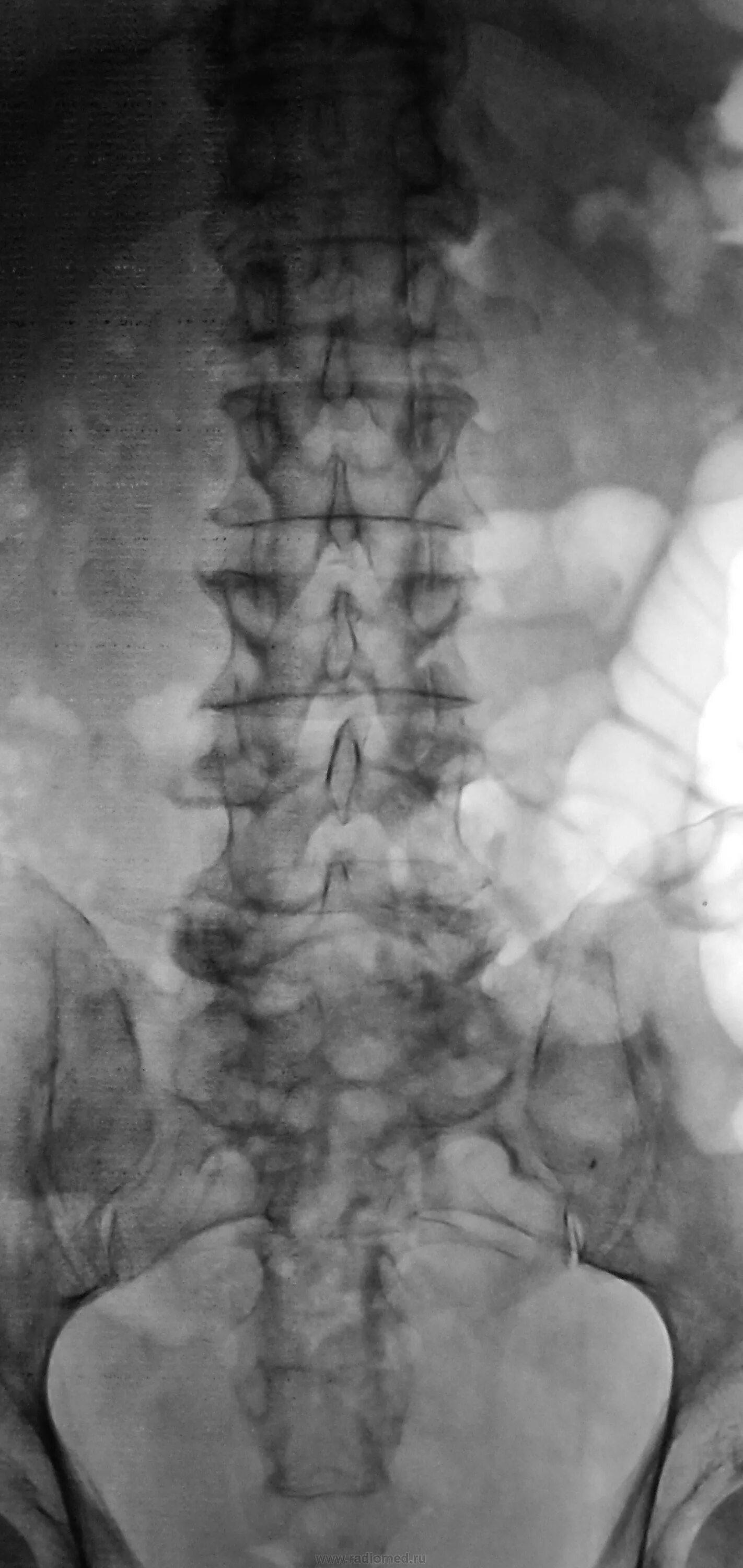 Рентген поясничного отдела фото Пациент направлен на рентгенографию костей таза и поясничного отдела позвоночник