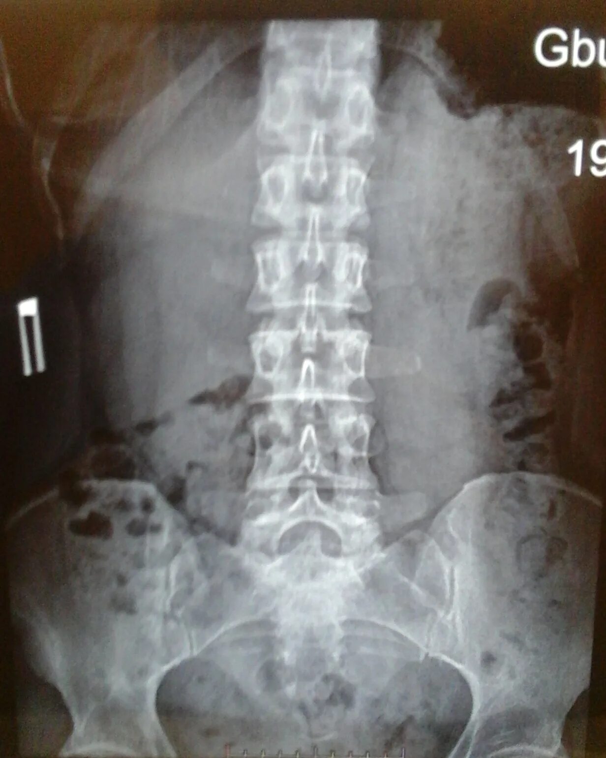 Рентген поясничного отдела фото поясничный отдел Рентгенограммы Сайт Тимура Гусейнова